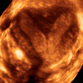 Deformed uterus,3-D ultrasound scan