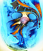 Uterine cancer,MRI scan