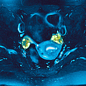 Polycystic ovaries,MRI scan