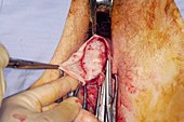 Vaginal prolapse repair surgery
