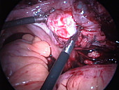 Fallopian tube operation