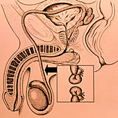 Artwork showing a vasectomy operation