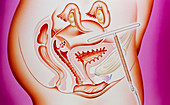 Artwork of an intrauterine device in the uterus