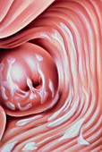 Illustration of candidiasis (thrush) of the cervix