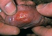 Close-up of penis affected by herpes simplex