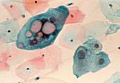 LM of cervical smear: Chlamydia infection
