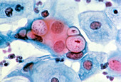 LM of cervical smear showing Chlamydia infection