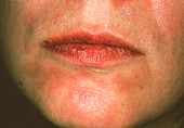 Secondary syphilis rash