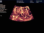 Inflamed testis,Doppler ultrasound