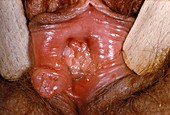Syphilis ulcer on vulva
