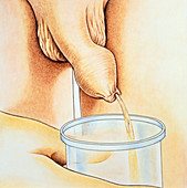 Illustration of phimosis: tightness of foreskin