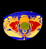 Col CT scan of enlarged prostate gland with cancer
