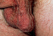 Man's scrotum with varicocele (varicose veins)
