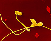 Coloured SEM showing deformed sperm