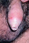 Penis with balanitis and xerotica obliterans