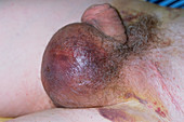 Haematoma of the scrotum