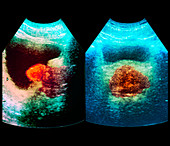 Enlarged prostate,ultrasound scan