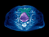 Prostate cancer,MRI