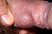 Sebaceous cyst on penis