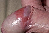 Inflamed penis