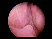 Enlarged prostate,endoscope image