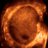 Testicular tumour,3-D ultrasound scan