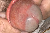 Inflamed penis