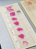Microscope slides of brain suspected of h