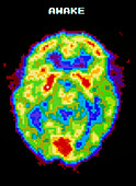 Coloured PET scan of human brain which is awake