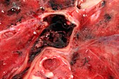 Lung blood clot,post-mortem