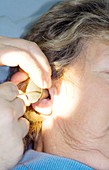 Ear microsuction