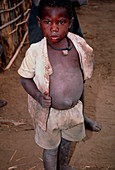 Boy with distended abdomen and medicine necklace