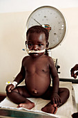Malnourished child being weighed