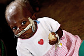 Malnourished child being fed