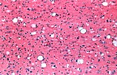 LM of mouse brain infected with scrapie