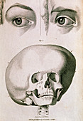Hydrocephalic skull