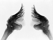 Bound feet of Chinese girl,X-ray
