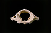 First cervical (atlas) vertebra of neck