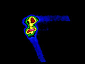 F/colour gamma scan of a normal human knee joint