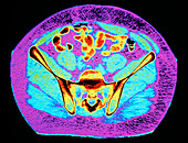 Coloured CT scan of a normal adult pelvis