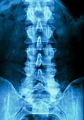 X-ray of normal human lumbar spine (lower back)