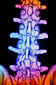 Coloured 3-D CT scan of lower spine