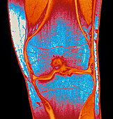 Coloured MRI of a section through a knee joint