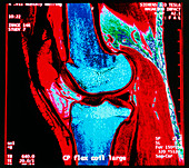 Coloured MRI scan of human knee joint,side view