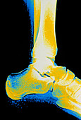 X-ray of ankle bones in the human foot