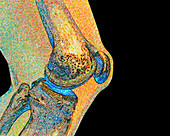 Artwork of human knee joint,side view
