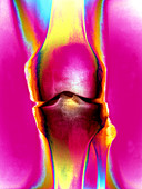 Coloured X-ray of a human knee joint
