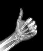 X-ray of a hand giving a thumb-up sign
