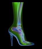 Coloured X-ray of woman's foot in high-heel shoe