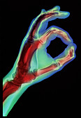 Coloured X-ray of a hand giving the OK si